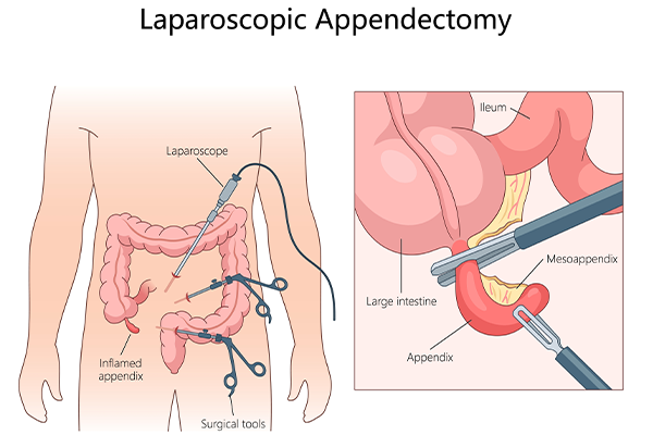 Appendix Appendicectomy