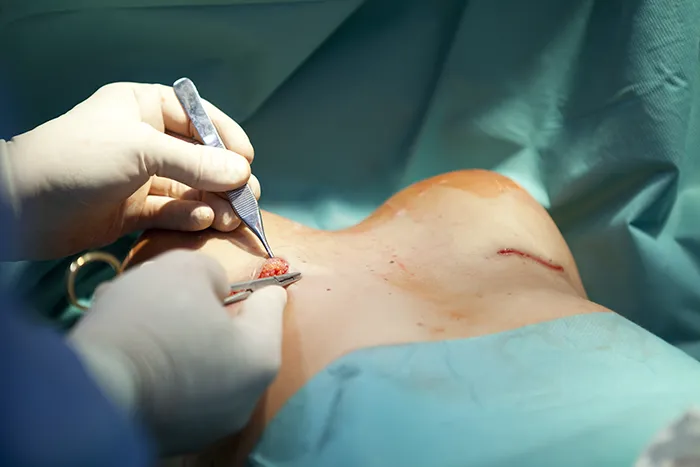 Breast Surgery