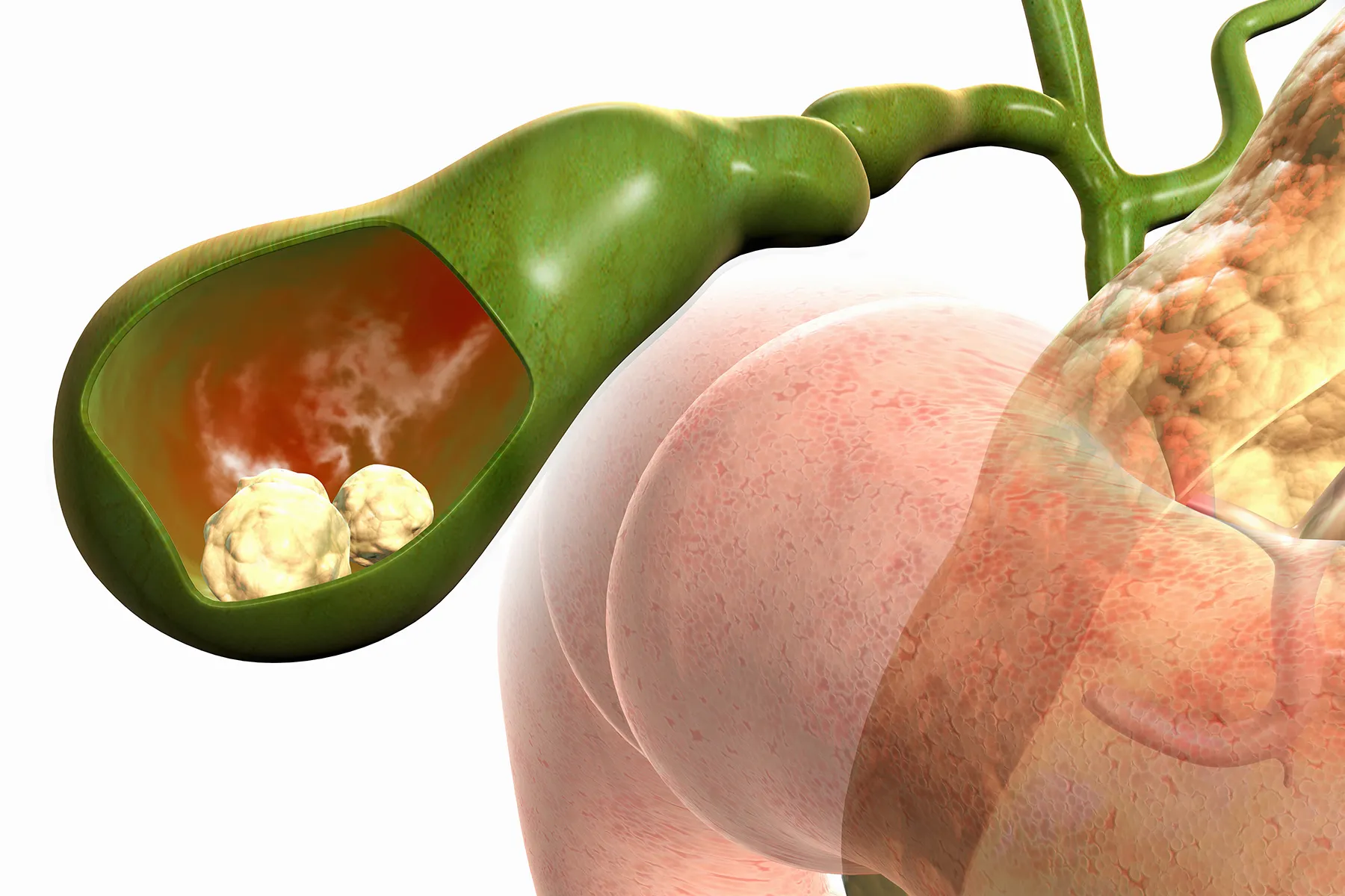 Gallbladder Stone Surgery