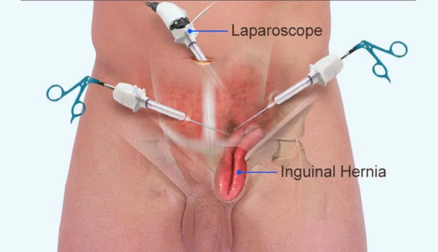 Laparoscopic Hernia Repair