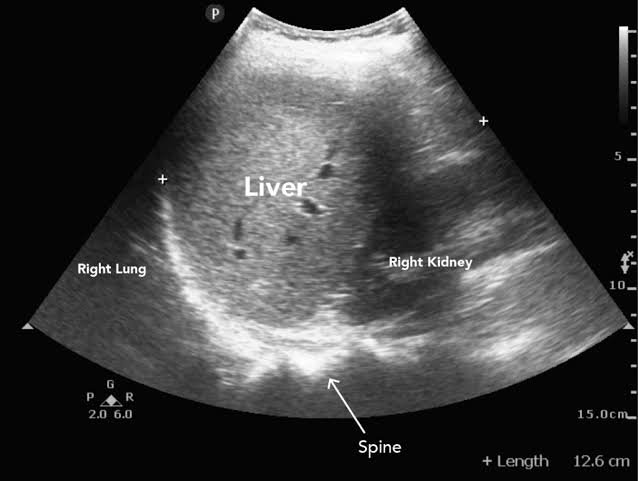 Abdominal Ultrasound