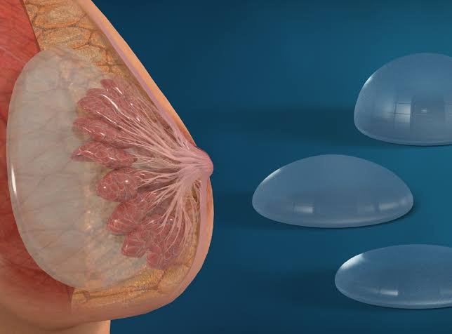 Breast Augmentation