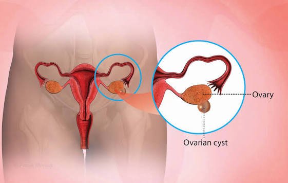 Cyst Treatment