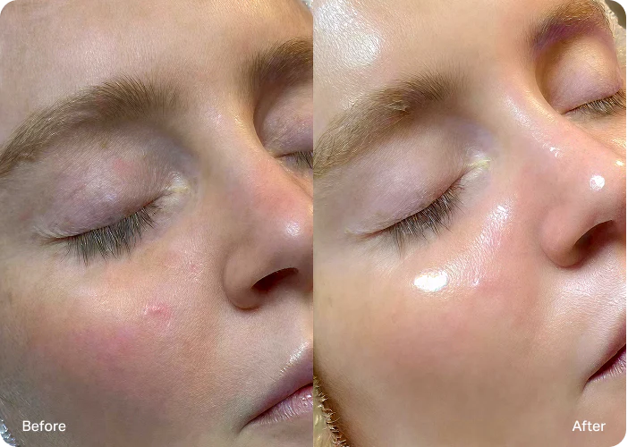 HydraFacial