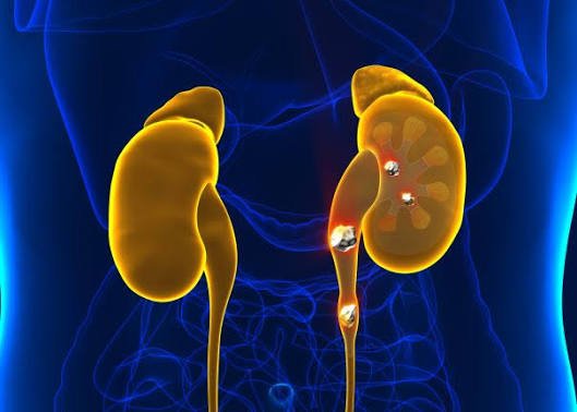 Kidney Stone Treatment