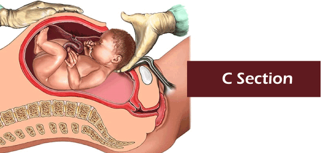 Caesarean Section