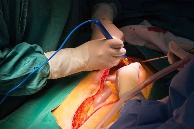 Laparotomy Surgery