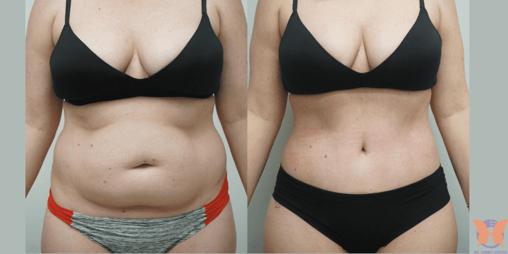 Liposuction