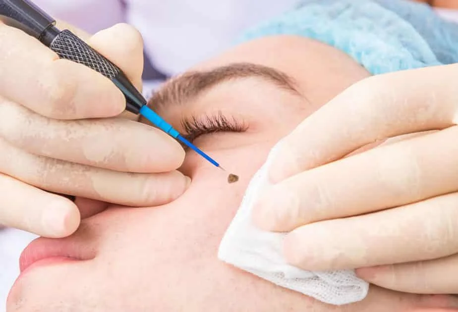 Mole Treatment