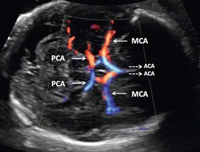 Obstetric Doppler