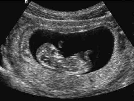 Obstetric Ultrasound