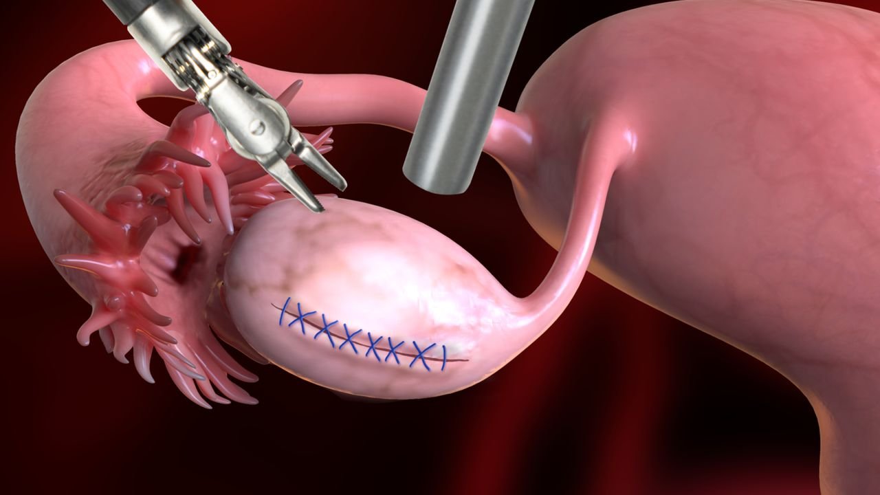 Ovarian Cystectomy