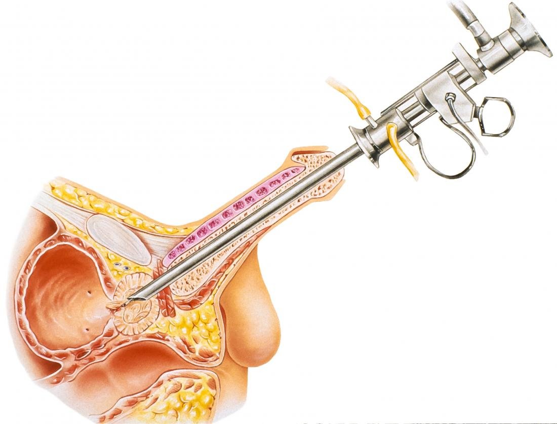 Prostate Related Surgical Treatment