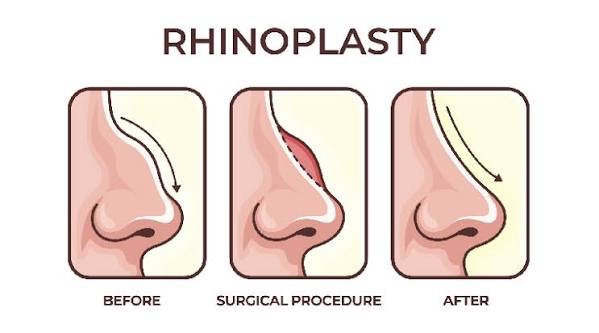 Rhinoplasty