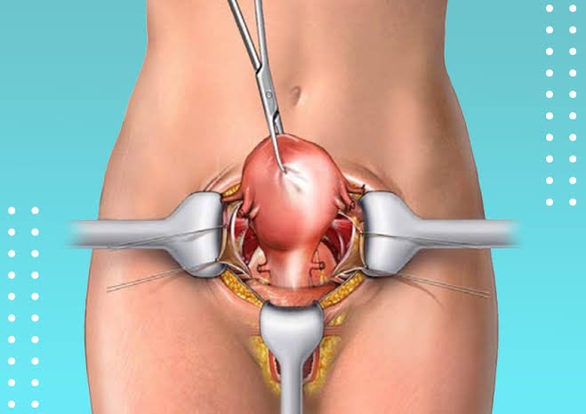 Total Abdominal Hysterectomy