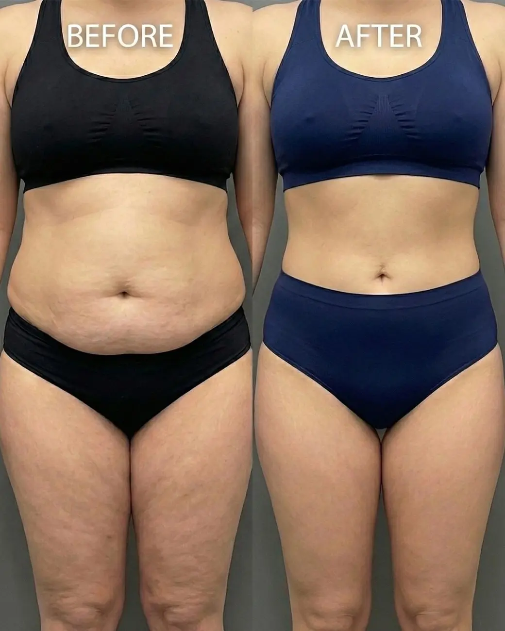 Tummy Tuck / Abdominoplasty
